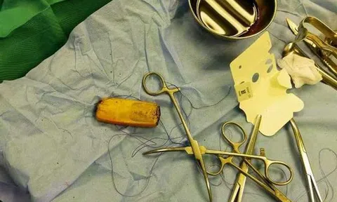 Người đàn ông nửa năm sống với chiếc điện thoại trong dạ dày