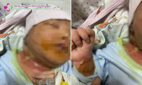 Sợ Covid-19, mẹ tự điều trị cho con khiến bé sơ sinh loét hết mắt, nghi nhiễm trùng máu