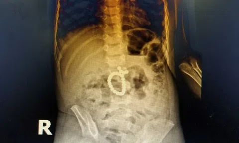 Bác sỹ giật mình trước cảnh tượng hàng chục viên bi nam châm trong bụng bé 3 tuổi