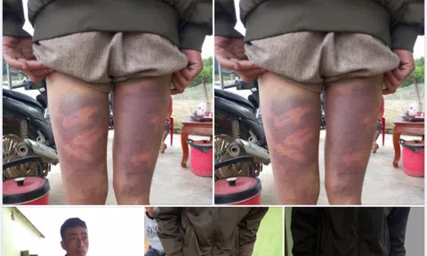 Người đàn ông tố bị đánh đập bầm tím 2 chân ở trụ sở xã