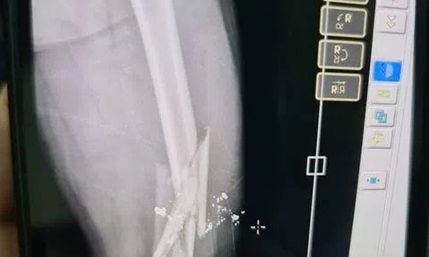 Mâu thuẫn trong cuộc nhậu, một người đàn ông bị bắn gãy xương đùi