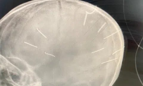 Hà Nội: Bé gái 3 tuổi nghi bị bạo hành, phát hiện nhiều vật thể nghi là đinh bắn vào sọ