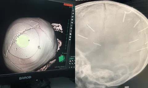 Vụ bé gái 3 tuổi bị bắn 9 cái đinh trong não: Ông nội gọi điện cầu cứu, bé từng ngộ độc thuốc trừ sâu 2 tháng trước