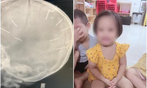 Bố ruột bé 3 tuổi có 9 dị vật giống đinh găm vào đầu: "Có ai muốn sát hại con tôi không?"