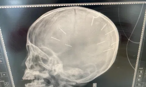 Rộ tin bé 3 tuổi bị đóng đinh vào đầu sắp được phẫu thuật rút đinh: Sự thật là gì?