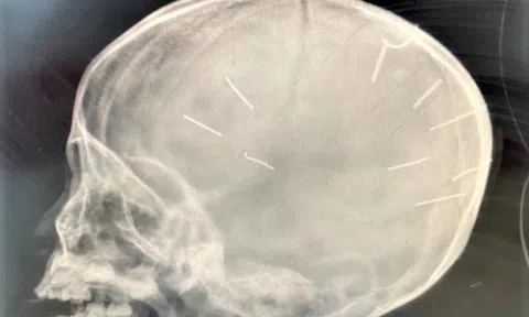 Bé gái 3 tuổi bị người tình của mẹ đóng đinh vào đầu hiện sức khỏe ra sao?