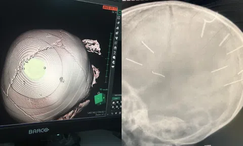 Vụ bé 3 tuổi bị nhân tình của mẹ đóng đinh ở đầu: Đáp ứng điều trị kém, tiên lượng dè dặt