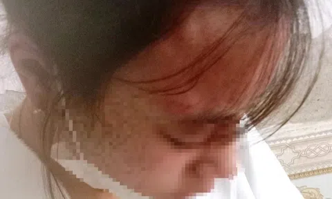 Đến quán tạp hóa mua kim khâu, nữ sinh lớp 10 bị chủ quán đánh đập dã man