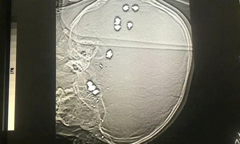 Bé trai 6 tuổi bị 11 viên đạn bi găm vào đầu