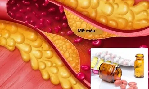 Thu hồi 4 thuốc điều trị tăng mỡ máu chống chỉ định với người châu Á