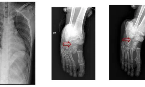 TP HCM: Thang máy rơi, hai người bị liệt 2 chân