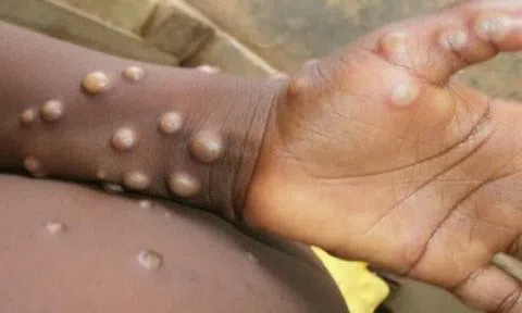 Giám sát, phát hiện ca nghi ngờ bệnh đậu mùa khỉ tại cửa khẩu