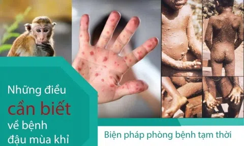 Những điều cần biết về bệnh đậu mùa khỉ