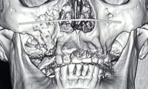Bộ Y tế yêu cầu xác định nguyên nhân gây bệnh hoại tử xương hàm mặt