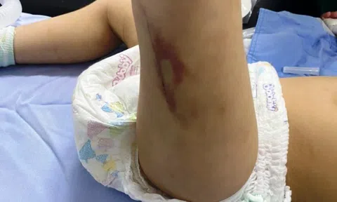 Đà Lạt: Bé 2 tuổi nghi bị bảo mẫu bạo hành đến chấn thương sọ não