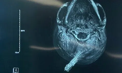 Chìa khóa cắm xương sọ nam thanh niên