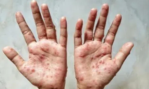 Nóng: Nguy cơ bệnh đậu mùa khỉ xâm nhập Việt Nam, Bộ Y tế họp khẩn