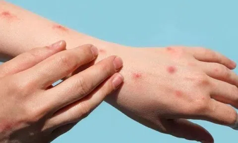 WHO: Đậu mùa khỉ chia 4 nhóm hành động, Việt Nam thuộc nhóm 1