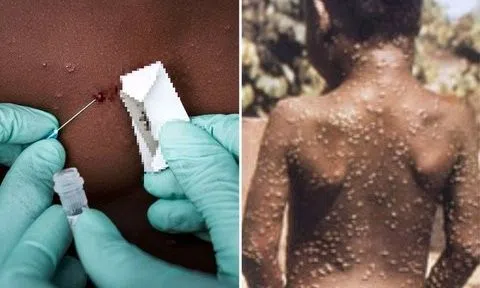 Tp.HCM triển khai giải pháp ứng phó với bệnh đậu mùa khỉ