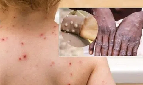 Châu Âu chấp thuận vắc-xin phòng đậu mùa khỉ