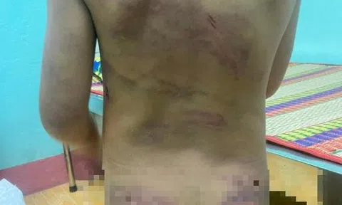 Bé gái mang đầy vết thương gây dậy sóng mạng xã hội ở cùng mẹ và cha dượng