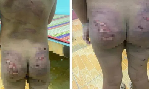 Từ vụ bé 7 tuổi bị cha mẹ bạo hành, Chủ tịch tỉnh Bình Phước chỉ đạo khẩn