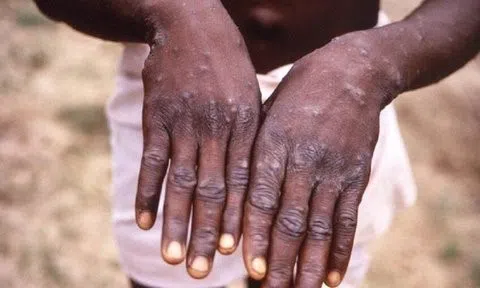 Chuyên gia cảnh báo không chủ quan trước nguy cơ bệnh đậu mùa khỉ