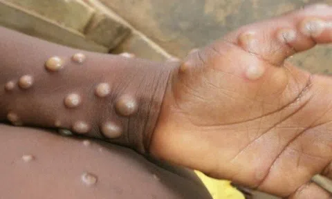 Phòng, chống bệnh đậu mùa khỉ “Sớm một bước, cao hơn một mức"