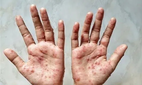 Sẵn sàng kịch bản ứng phó với bệnh đậu mùa khỉ