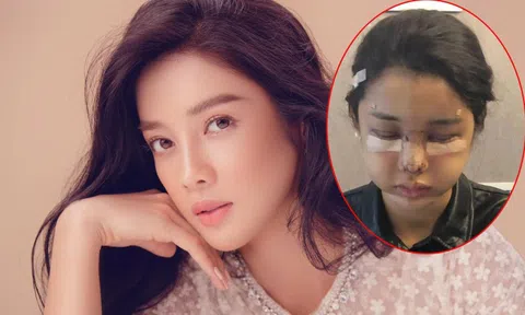 'Nàng Kiều' Trình Mỹ Duyên công khai hình ảnh phẫu thuật thẩm mỹ