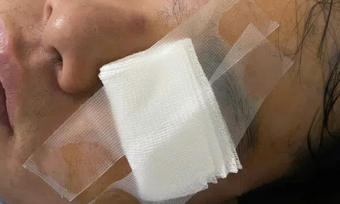 Nam thanh niên nhập viện vì "va vào gậy của CSGT" nói gì?